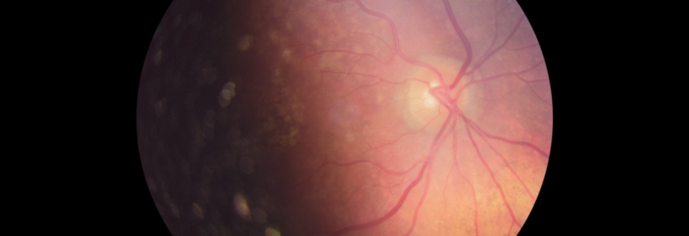 Gene Therapy May Rescue Visual Acuity in People with LHON Disease
